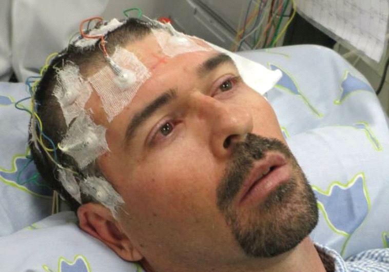 Electrodes connected to an EEG help to track seizures caused by a brain tumor that is an inoperable cancer
